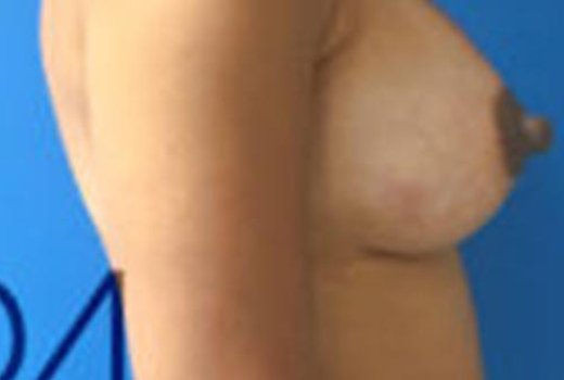 Augmentation mammaire par prothèse à Lyon. Dr Romain AIMARD