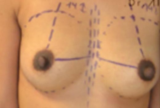 Augmentation mammaire par prothèse à Lyon. Dr Romain AIMARD