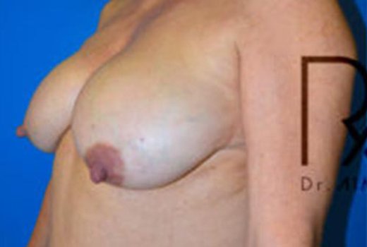 Réduction mammaire à Lyon. Dr Romain AIMARD