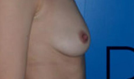 Augmentation mammaire par lipostructure à Lyon. Dr Romain AIMARD
